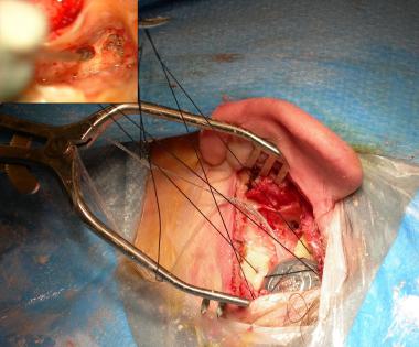 Cochlear Implant Process