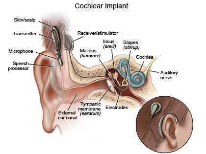 Cochlear Implant Device